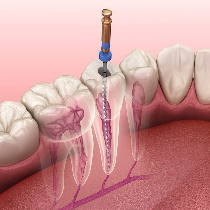 Microscopic endodontics and root canal therapy